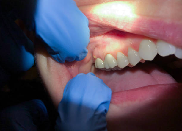 Best Cracked Tooth Emergency Dentist  in Stanley, WI